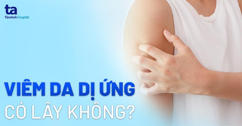 Viêm da dị ứng: Nguyên nhân, triệu chứng và cách phòng ngừa