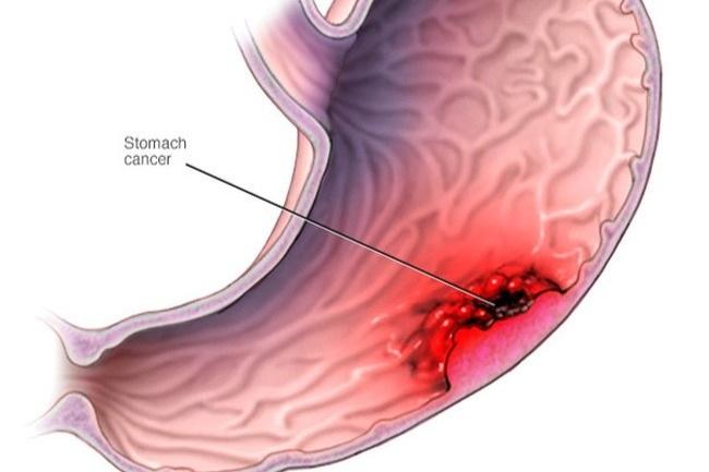 U ác tính dạ dày có chữa được không? - 1