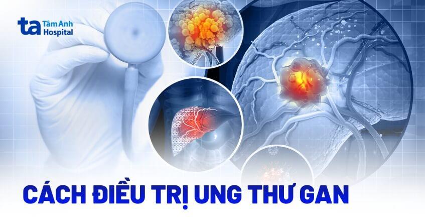 8 phương pháp điều trị ung thư gan phổ biến hiện nay