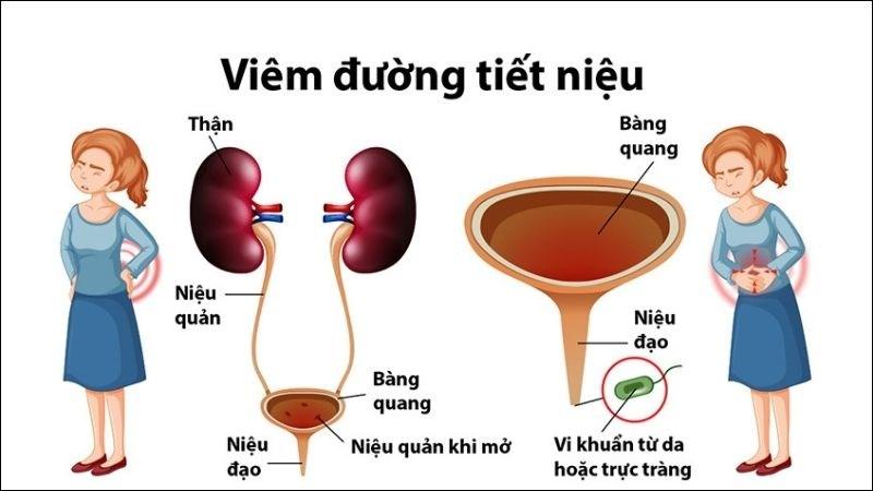 Vi khuẩn xâm nhập và tấn công đường tiểu gây viêm đường tiết niệu