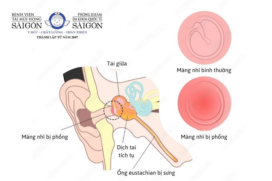 Viêm tai giữa bao lâu thì khỏi? Có để lại biến chứng nguy hiểm không?