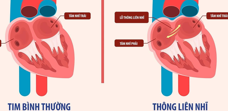 Chi phí phẫu thuật tim thông liên nhĩ là bao nhiêu? 1