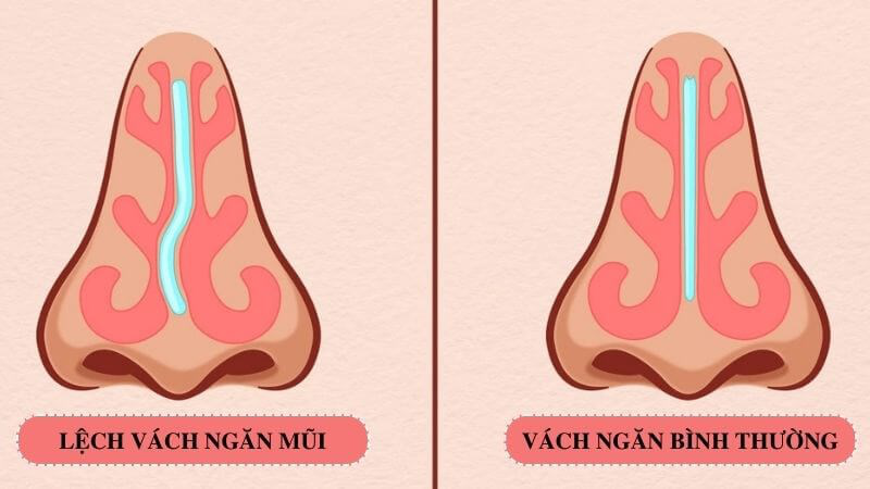 Phẫu thuật vách ngăn mũi giá bao nhiêu? Thời gian hồi phục sau phẫu thuật 1