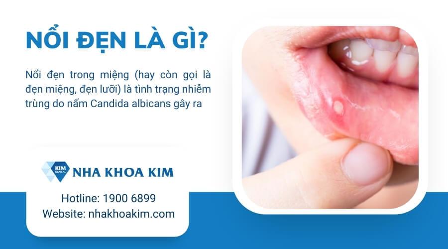 Nổi đẹn là gì? Nguyên nhân và cách điều trị đẹn lưỡi