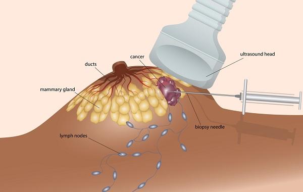 Siêu âm tuyến vú mục đích, đối tượng, vai trò tầm soát ung thư vú