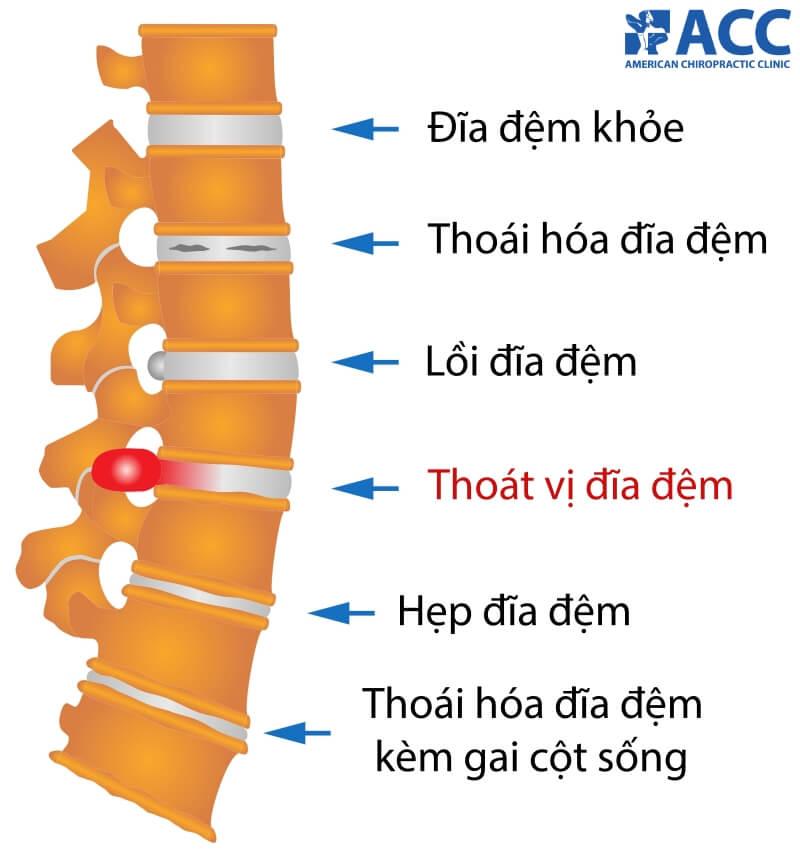 thoát vị đĩa đệm chèn ép dây thần kinh