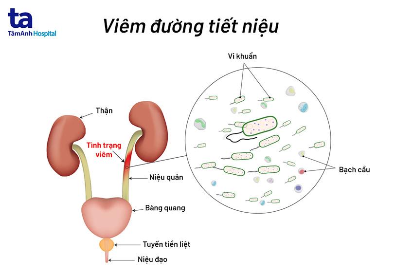 mô tả viêm đường tiết niệu