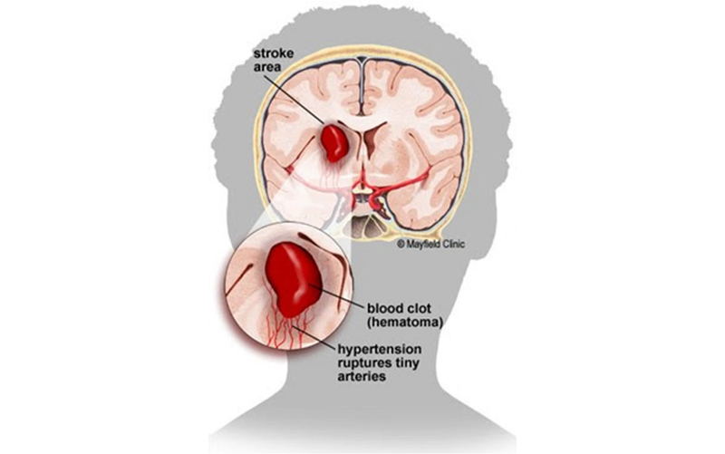 Tụ máu não: Nguyên nhân, dấu hiệu và cách phòng tránh