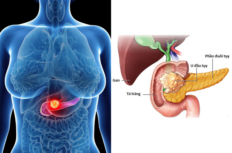 U đầu tụy có nguy hiểm không? U đầu tụy điều trị thế nào?