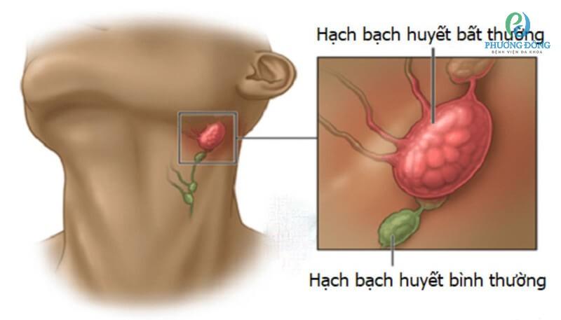 Ung thư hạch: Nguyên nhân, triệu chứng và cách phòng ngừa