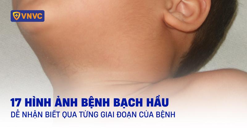 17 hình ảnh bệnh bạch hầu thực tế, dễ nhận biết qua từng giai đoạn