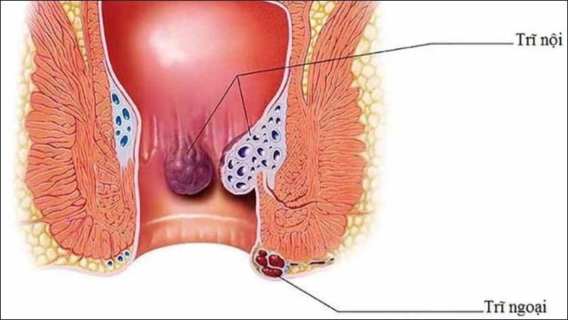 Bệnh trĩ bao gồm trĩ nội và trĩ ngoại