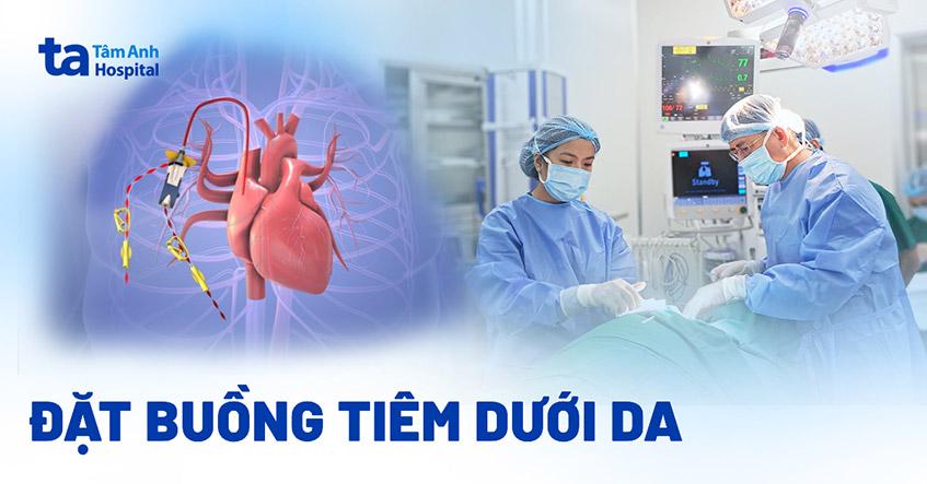 Đặt buồng tiêm dưới da là gì? Ưu điểm, chỉ định và quy trình [A-Z]