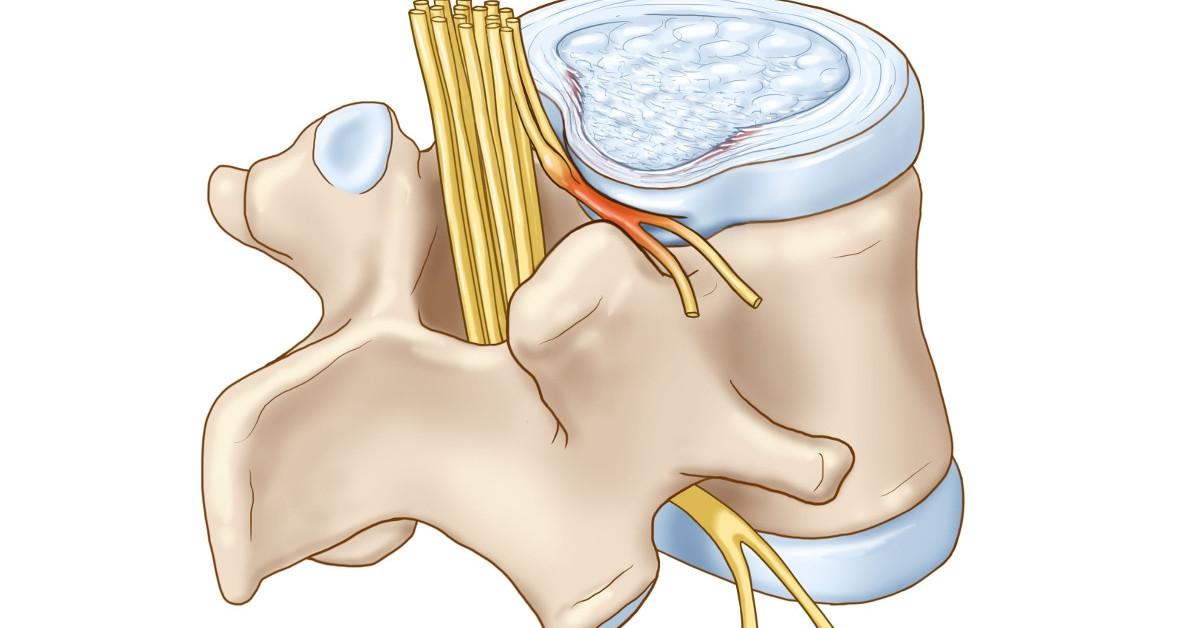 Chèn éo dây thần kinh