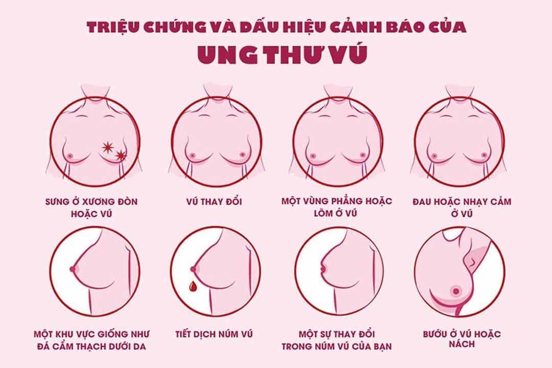 Tầm soát ung thư vú định kỳ để tăng tỷ lệ khỏi bệnh