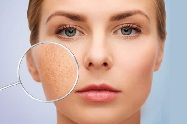 Dùng Niacinamide bị rát, kích ứng và cách khắc phục