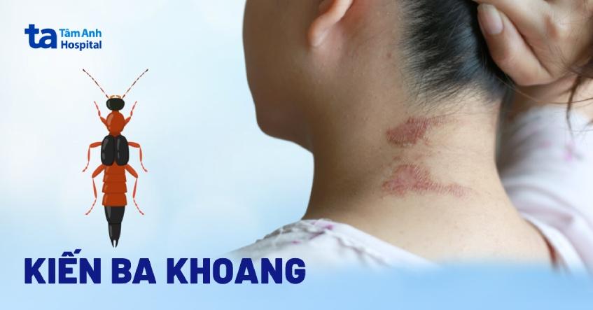 kiến ba khoang là kiến gì