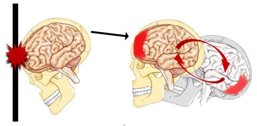 Đụng dập nhu mô não