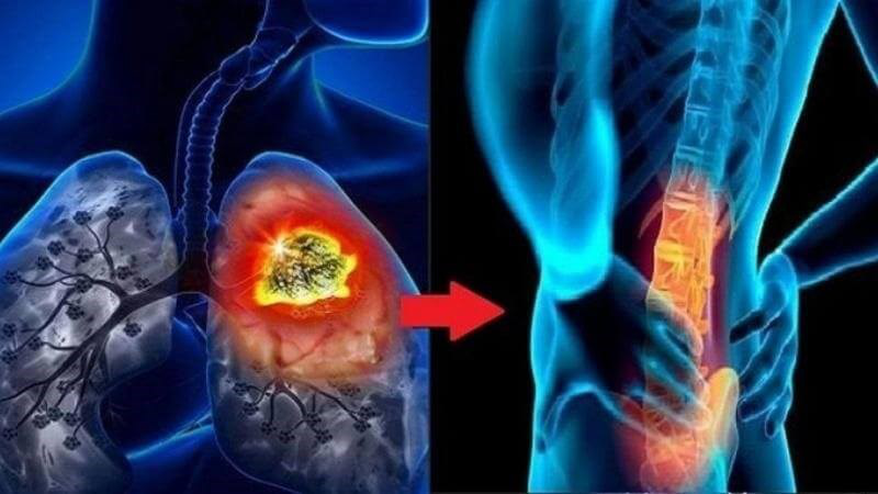 Ung thư di căn xương sống được bao lâu? Dấu hiệu, nguyên nhân và điều trị