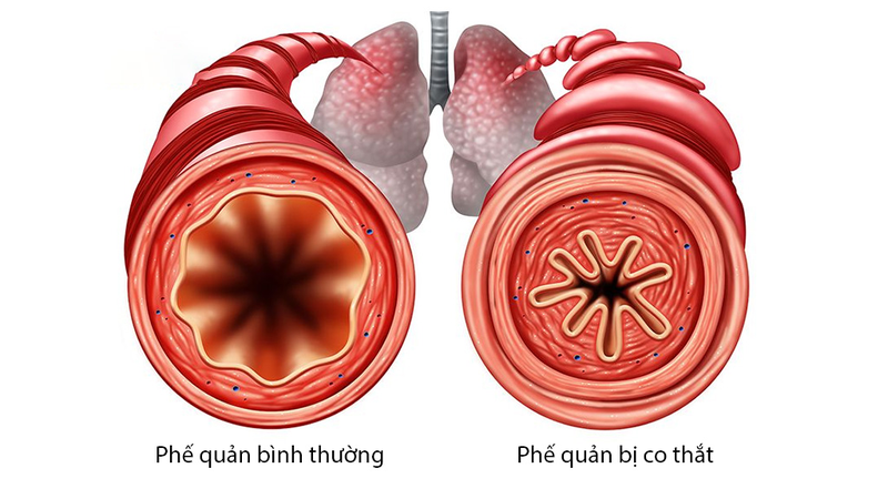 Co thắt phế quản dùng thuốc gì? Có điều trị dứt điểm được không?