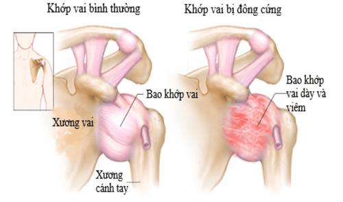 Viêm khớp: Nguyên nhân, triệu chứng, chẩn đoán và điều trị