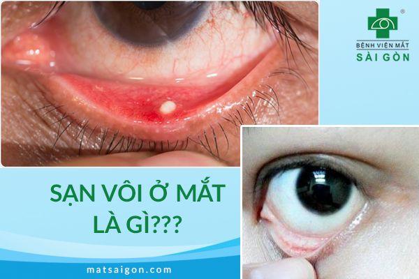 sạn vôi ở mắt là gì