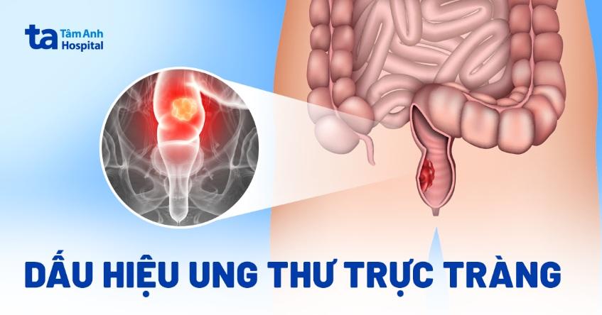 dấu hiệu ung thư trực tràng