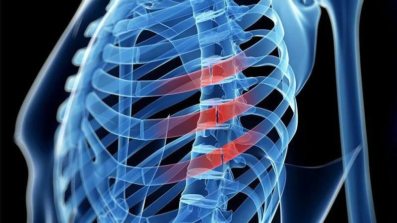 Gãy xương sườn số 5 6 7 có nguy hiểm không?