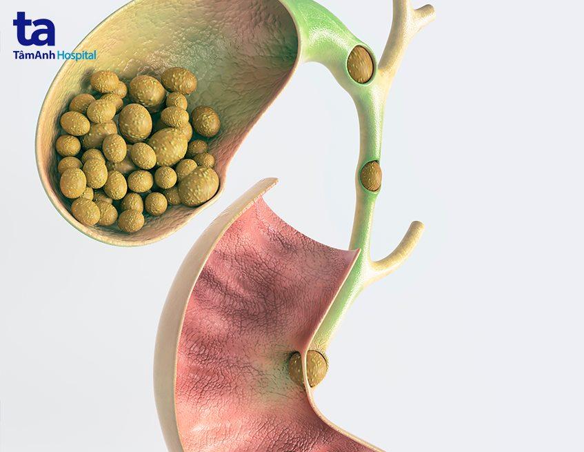 chỉ định cắt túi mật