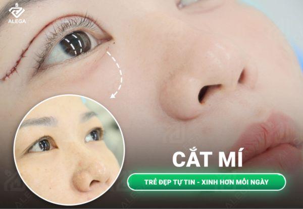 Bao nhiêu tuổi thì mới cắt mí mắt được?