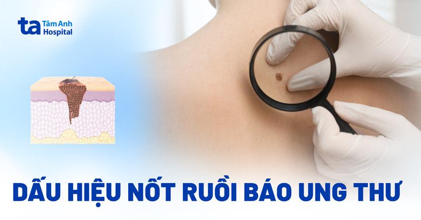 Dấu hiệu nốt ruồi báo ung thư dễ nhận biết (kèm hình ảnh)