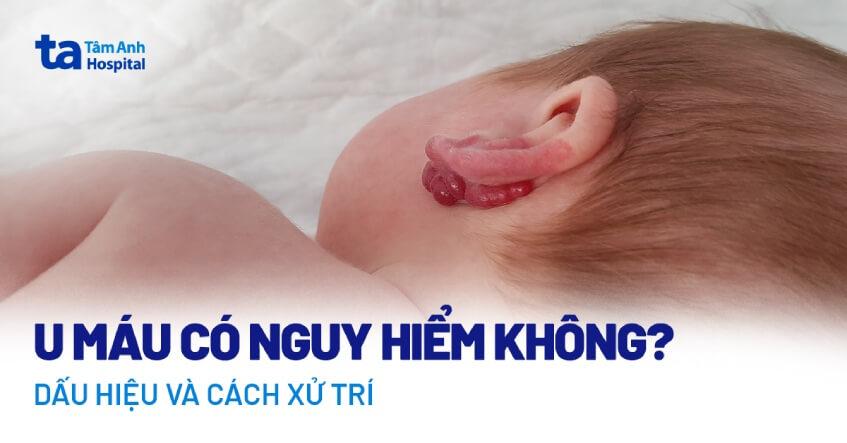 U máu có nguy hiểm không? Xử trí khi có dấu hiệu mắc bệnh?