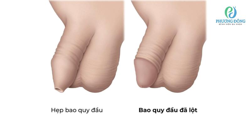Chuyên gia giải đáp: Bao nhiêu tuổi thì lột bao quy đầu?