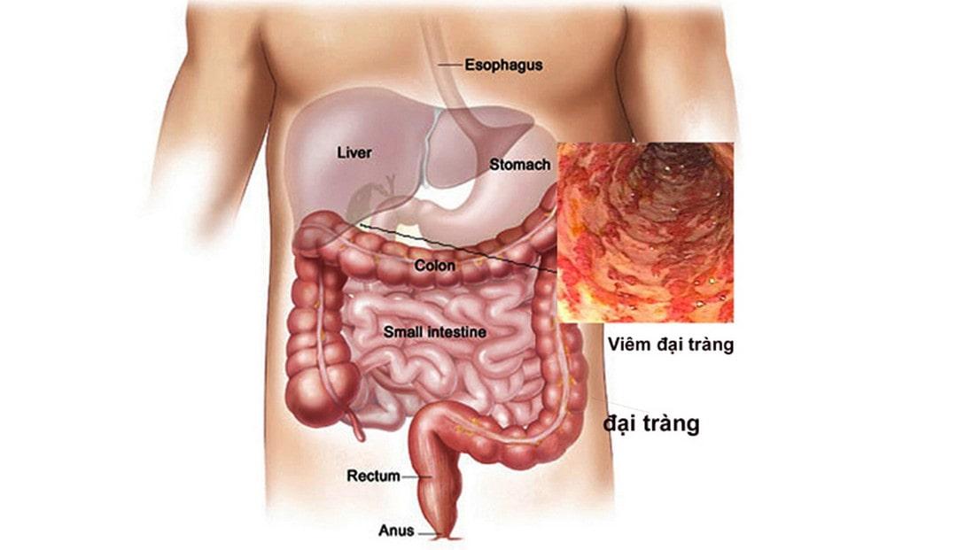 Đau bụng bên trái thường do cơ quan tại vùng này bị tổn thương