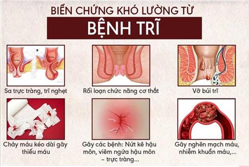 Chi phí cắt trĩ hết bao nhiêu tiền? Bảng giá chữa bệnh trĩ năm 2025