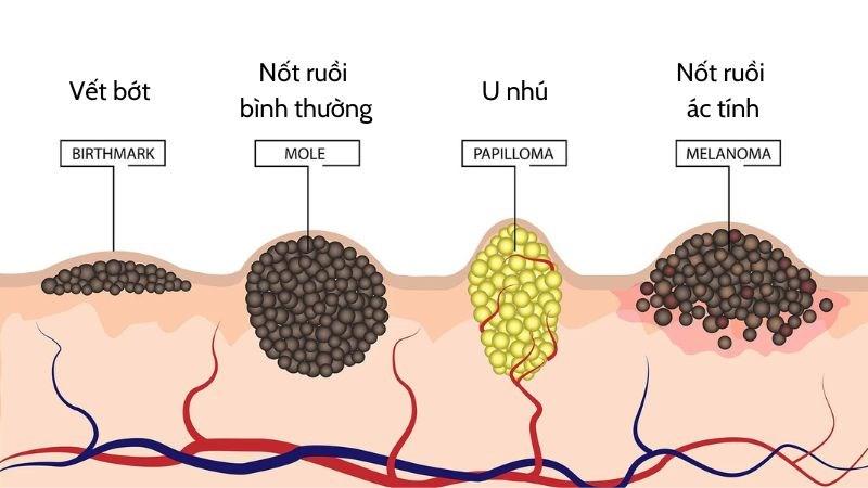 6 cách nhận biết nốt ruồi ác tính, cách điều trị và phòng ngừa