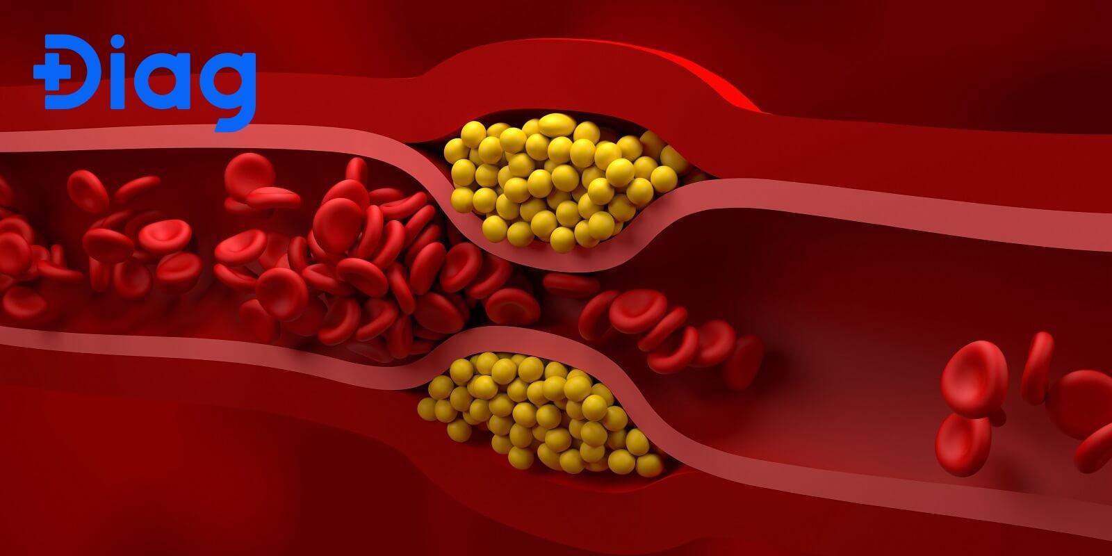 Công thức tính LDL cholesterol và công thức tính HDL cholesterol