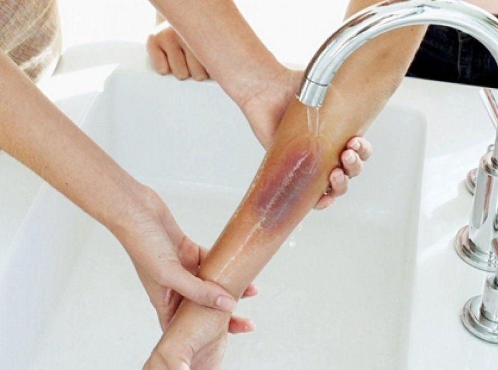 Sơ cứu đúng khi bị bỏng bô, bỏng nhiệt