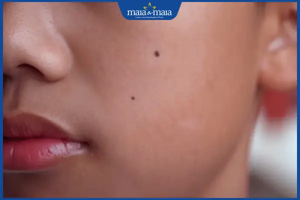 Xem tướng nốt ruồi ở má nam và nữ giới. Nên tẩy hay không?