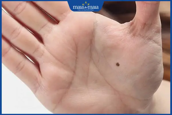 Nốt ruồi ở tay tốt hay xấu? Xem tướng số ở nam và nữ giới