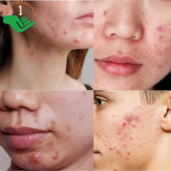 Top 10 kem trị mụn bọc hiệu quả nhanh, giảm sưng và không bị thâm