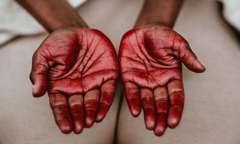 Dị ứng xà phòng: Nguyên nhân, triệu chứng và cách điều trị