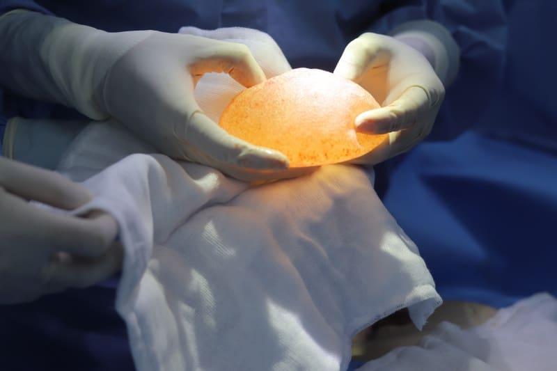 Ngực thông khe, thiếu cực ngoài sau hơn 10 năm nâng ngực