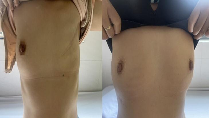 KHÁM PHÁT HIỆN SỚM UNG THƯ VÚ: XIN ĐỪNG XEM NHẸ!