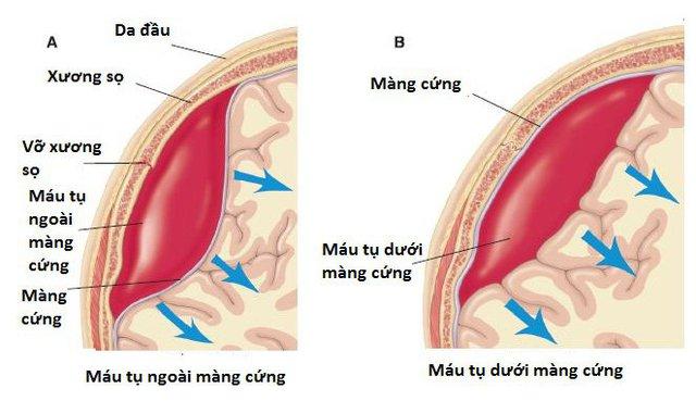 Sau ngã, va đập có biểu hiện đau đầu, nói ngọng, buồn nôn… thận trọng với tụ máu dưới màng cứng